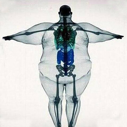一张真实的X光片，胖子版
